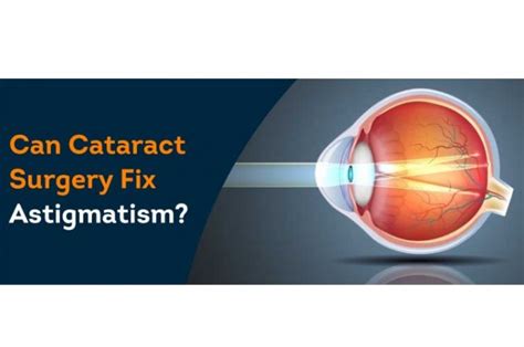 Cataract Cataract Surgery Astigmatism