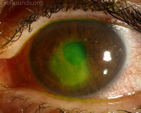 Recurrent Corneal Erosion Syndrome Rces Causes And Treatment