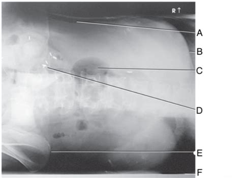 Ap Abdomen Left Lateral Decubitus And Left Dorsal Decubitus Position