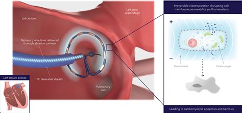 Pulsed Field Ablation For The Treatment Of Atrial Fibrillation Pulsed