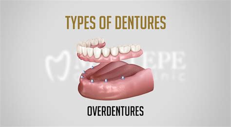 Denture Adhesives Types Top Brands And Choosing Factors