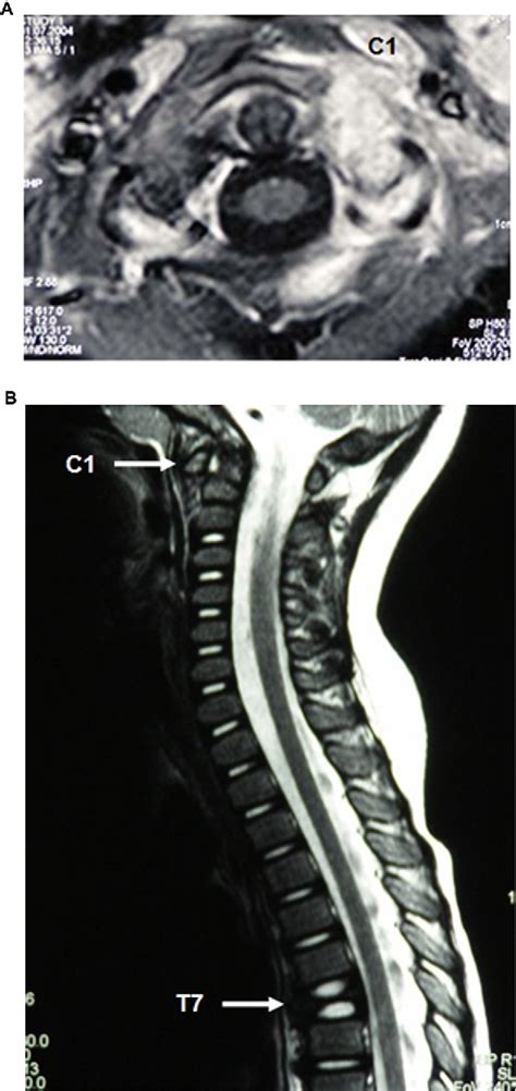 Figure 2 from Eosinophilic granuloma of the spine involving C1 and ...