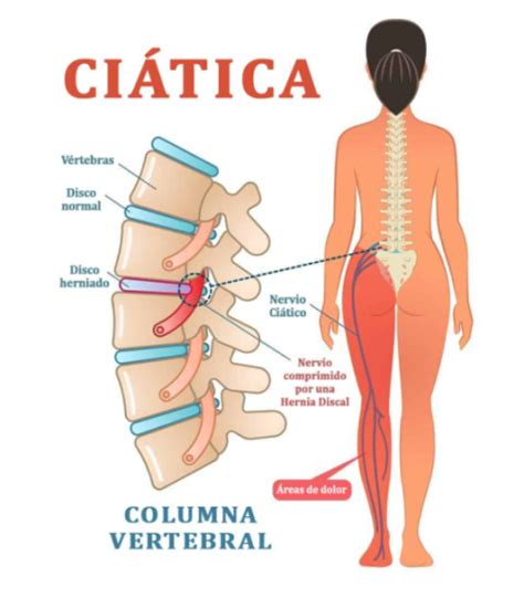 Lumbalgia Ci Tica Y Ciatalgia M S Kinesio