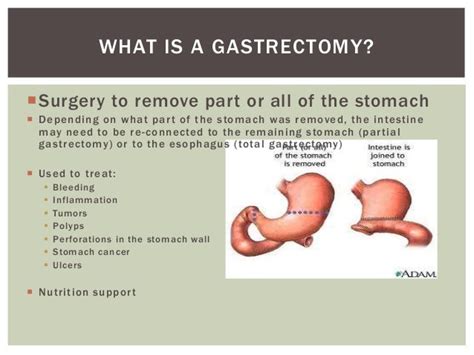 Upper Partial Gastrectomy Diet - devilposts