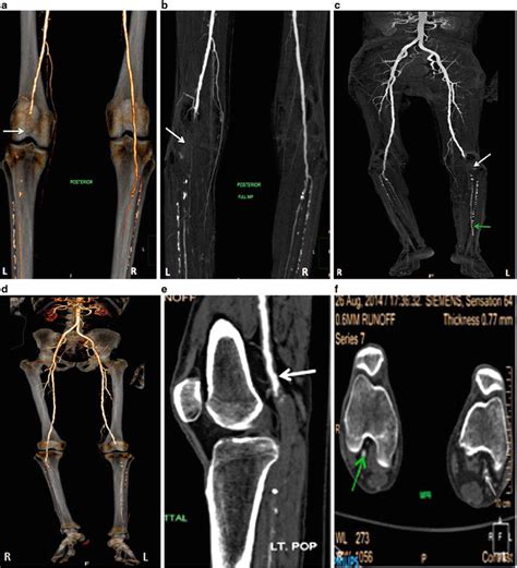 Ct Evaluation Of Critical Limb Ischemia Thoracic Key