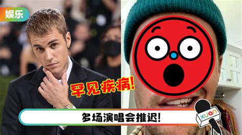 Justin Bieber患上罕见疾病！ 无法控制脸部表情右边脸完全面瘫！ Xuan