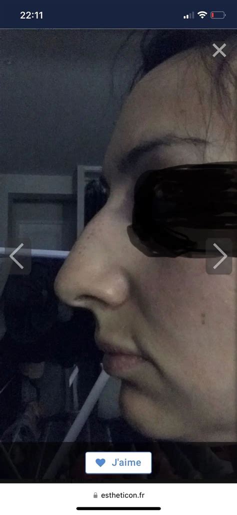 Rhinoplastie M Dicale Possible Rhinoplastie M Dicale Ou Correction