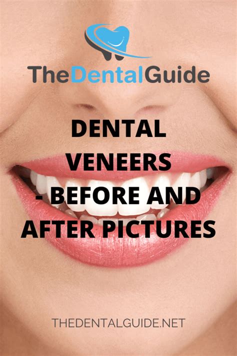 Dental Veneers - Before and After Pictures - The Dental Guide