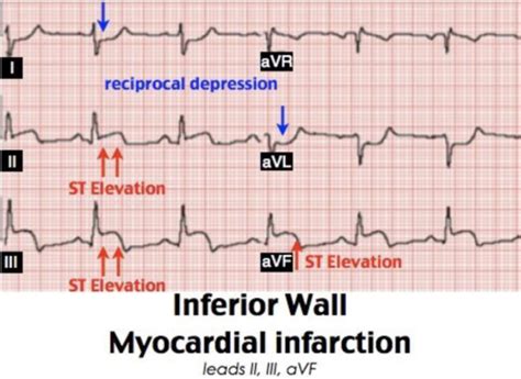 Ch Critical Care Of Patients With Acute Coronary Syndromes