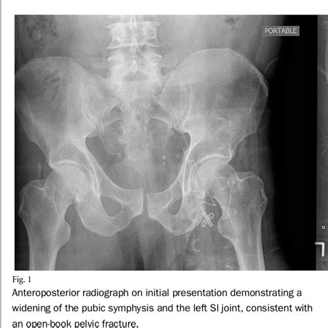 Figure 1 from Delayed Bone Infarct in the Ilium Following a Pelvic ...