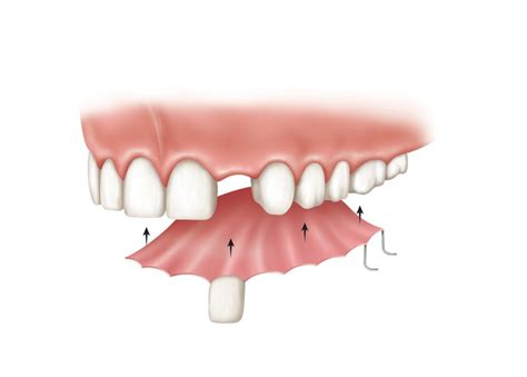 Single Tooth Denture - Dental News Network