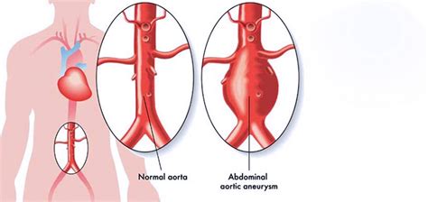 Abdominal Aortic Aneurysm Surgery - Healthsoul