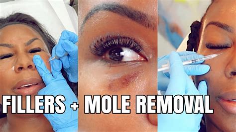 Black Eye Dissolving Tear Troughs Filler Laser Mole Removal Youtube