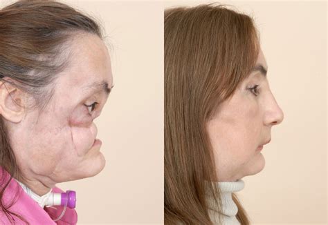 Americas First Face Transplant Patient Connie Culp Who Had Surgery