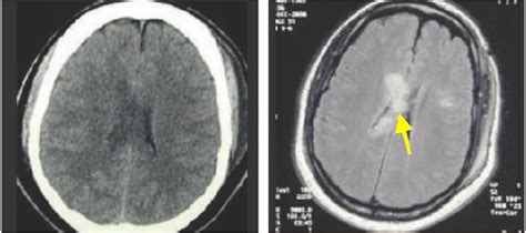 Ct And Mri Scans Showing Lesions Compatible With Diffuse Axonal Injury