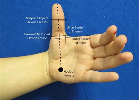 Hand Surface Landmarks And Measurements In The Treatment Of Trigger Thumb Journal Of Hand Surgery