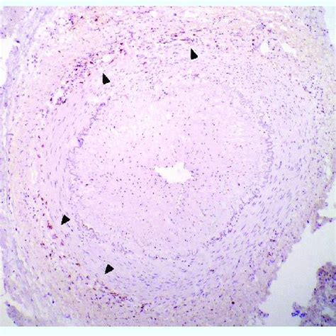 Temporal artery biopsy from a patient with giant-cell arteritis taken ...