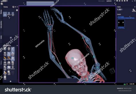 Cta Brachial Artery Ct Scan Upper Stock Illustration 1981012559