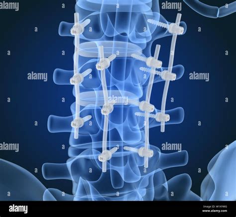 Spinal Fixation System Titanium Bracket X Ray View 3d Illustration