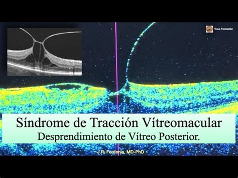 S Ndrome De Tracci N V Treomacular Desprendimiento De V Treo Posterior