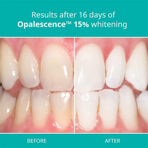 Opalescence Instructions How To Apply The Gel And Commonly Asked