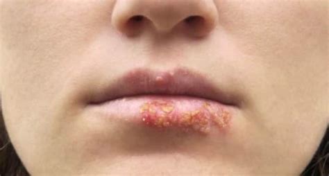 8 Highly Contagious Skin Diseases That You Should Be Aware Of