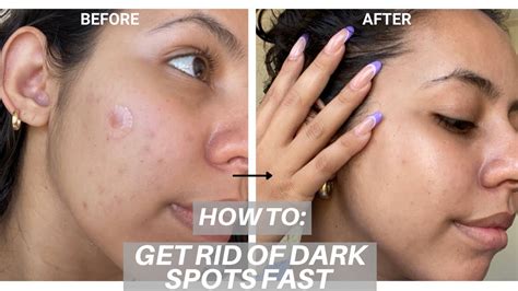 Help Visibly Reduce Dark Spots And Hyperpigmentation Ft Hyper Skin