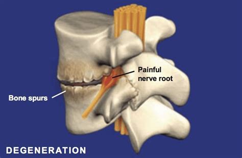 Spondylosis - Degeneration of the Spine | Florida Surgery Consultants