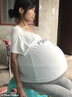 Chinese Mother Of Two Whose Belly Ballooned By Pounds Due To Ovarian