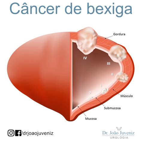 C Ncer De Bexiga Dr Jo O Juveniz