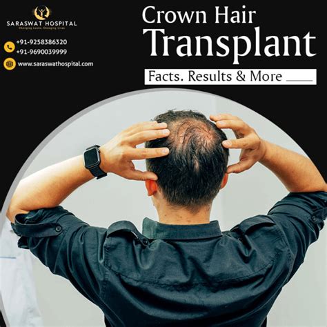 What Should You Know About Crown Hair Loss Treatment In Agra