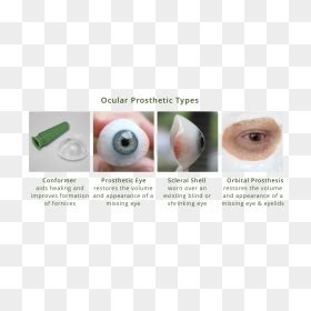 Ocular Prosthesis Types Diagram - Ocular Implant, HD Png Download - vhv