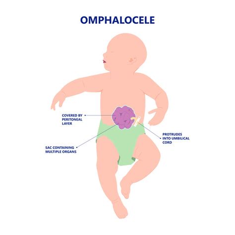 Omphalocele - Gejala, penyebab dan mengobati - Alodokter