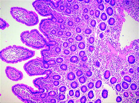 Histopathology Section Of Duodenal Mucosa Demonstrating Moderate Degree