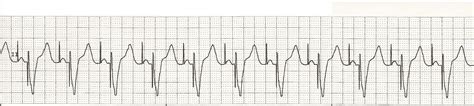 Float Nurse: EKG Rhythm Strip Quiz 14