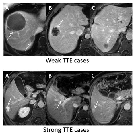 Delayed Mri Enhancement Of Colorectal Cancer Liver Metastases Is Associated With Metastatic