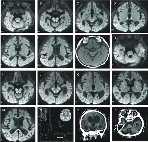 Imaging Of Patients Ii 1 And Ii 2 A F Symmetrical Lesions In The Download Scientific Diagram