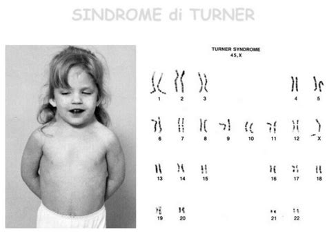 Disgenesia Ovarica 46XX Con Bassa Statura Un Analisi Patologica