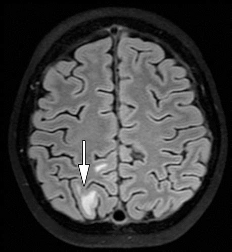 Radiologic Clues To Cerebral Venous Thrombosis Radiographics