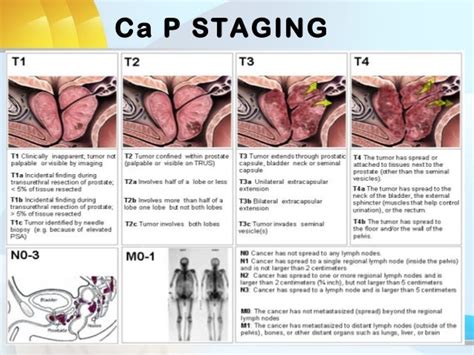 Locally Advanced Prostate Cancer