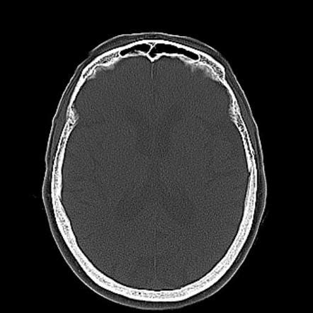 Senile Calcific Scleral Plaques Image Radiopaedia Org