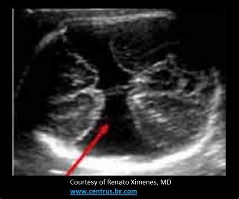 OB GYN CTL 2nd 3rd Trimester Pathology P1 Flashcards Quizlet