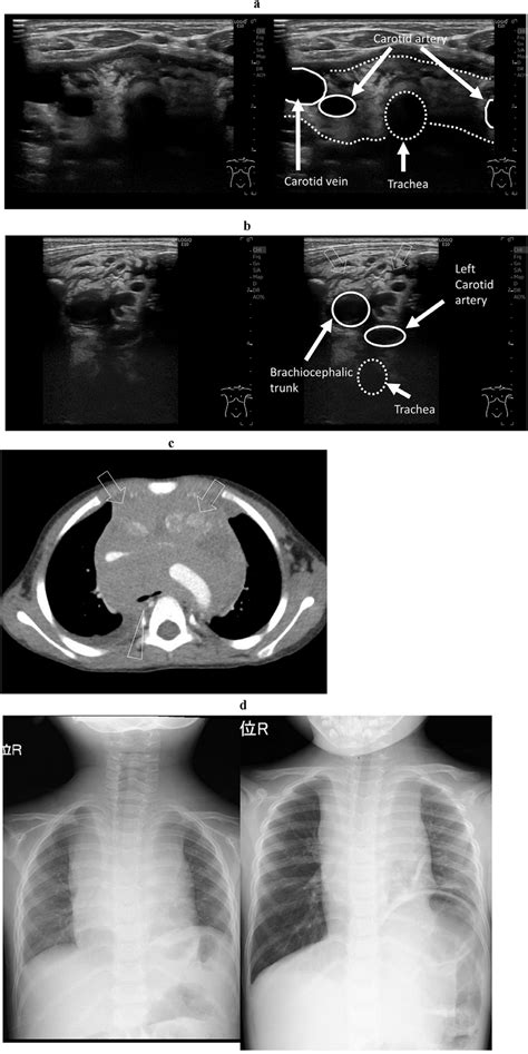 A Year Old Girl With An Anterior Mediastinal Mass Due To T Cell