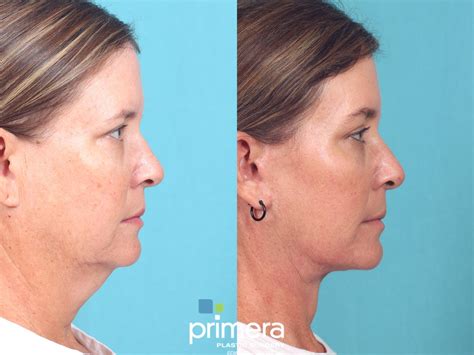 Endoscopic Forehead Lift Before And After Photo Gallery Orlando