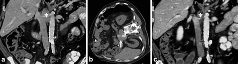 CT Guided Percutaneous Needle Biopsy Of Retroperitoneal And Pelvic