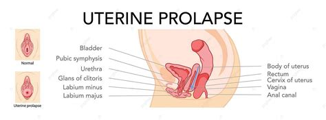 Labelled Uterine Prolapse Female Reproductive Anatomy Infographic Female Cervix Vagina Vector