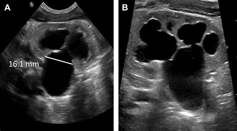 Prenatal Urinary Tract Dilatation Urologic Clinics