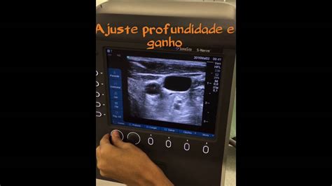 Tutorial Para Acesso Venoso Central Guiado Por Ultrassom Abordagem