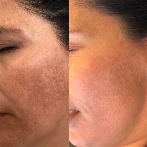 Melasma Gallery Nu Image Medical Esthetics