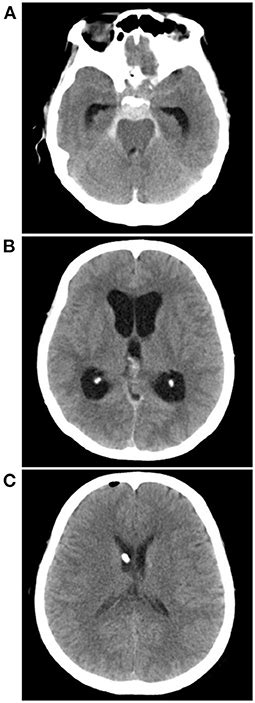 Frontiers Current Status Of Perimesencephalic Non Aneurysmal